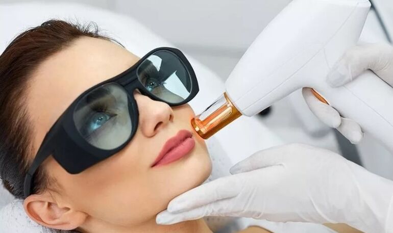 Laser skin rejuvenation