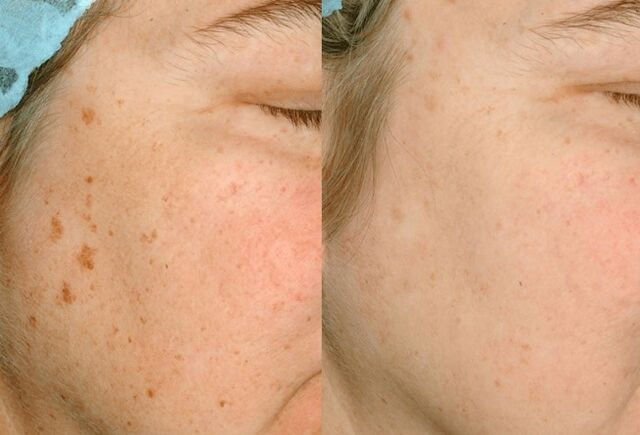 Removal of skin pigmentation